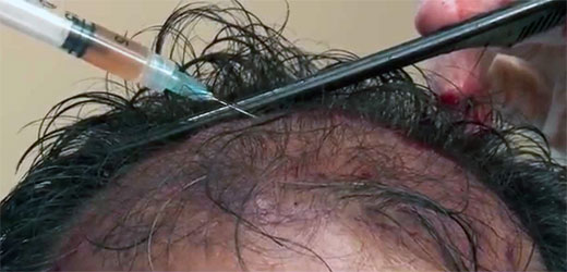 ALOPECIA PRP