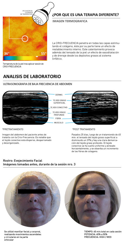 Crio-Radiofrecuencia