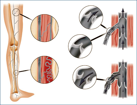 ESCLEROSIS QUIMICA