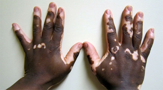 VITILIGO