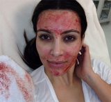 Tratamiento facial del vampiro (vampire facelift)