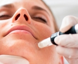 Microneedling: la mesoterapia que abre ms de 1.000 microcanales por segundo